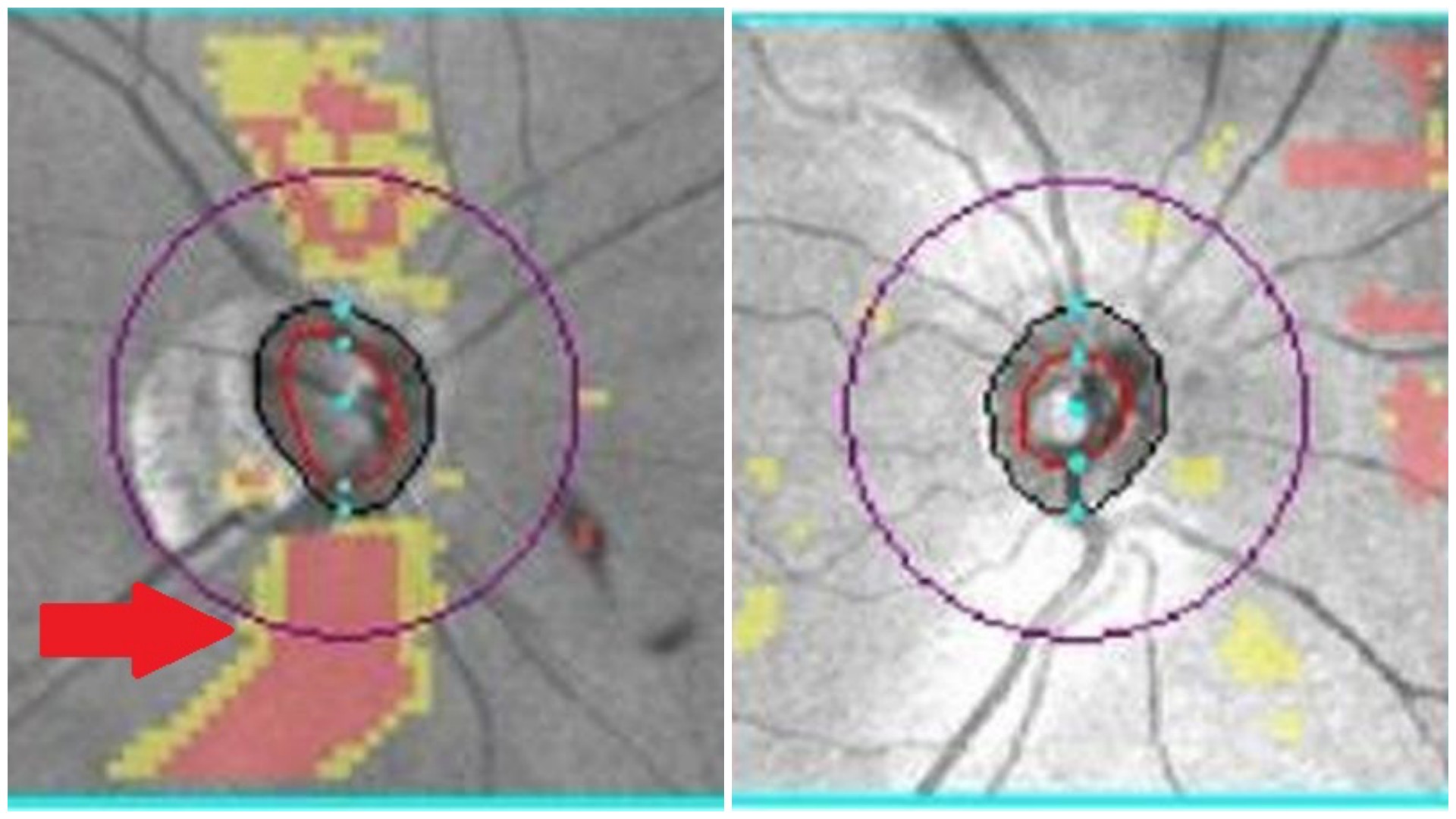 左圖為經光學同調斷層掃描後顯示視網膜神經纖維缺損(箭頭處)，有青光眼的病變；右圖為正常的視神經盤掃描圖。