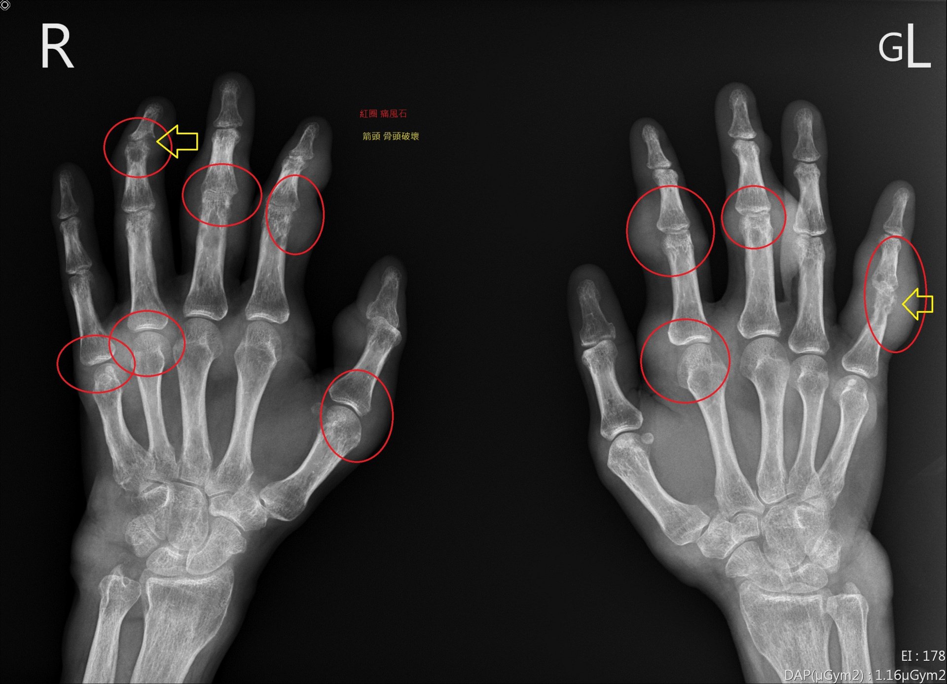 痛風患者手部X光片，紅圈為痛風石，黃色箭頭為遭破壞骨頭。