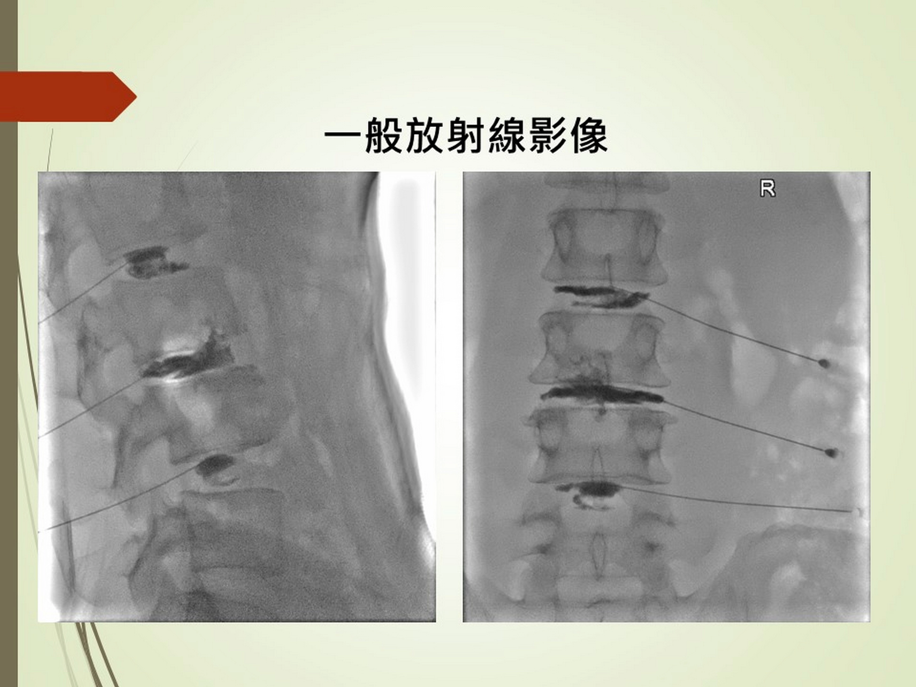 放射線多重影像導引設備可提供一般放射線影像供醫師參考。