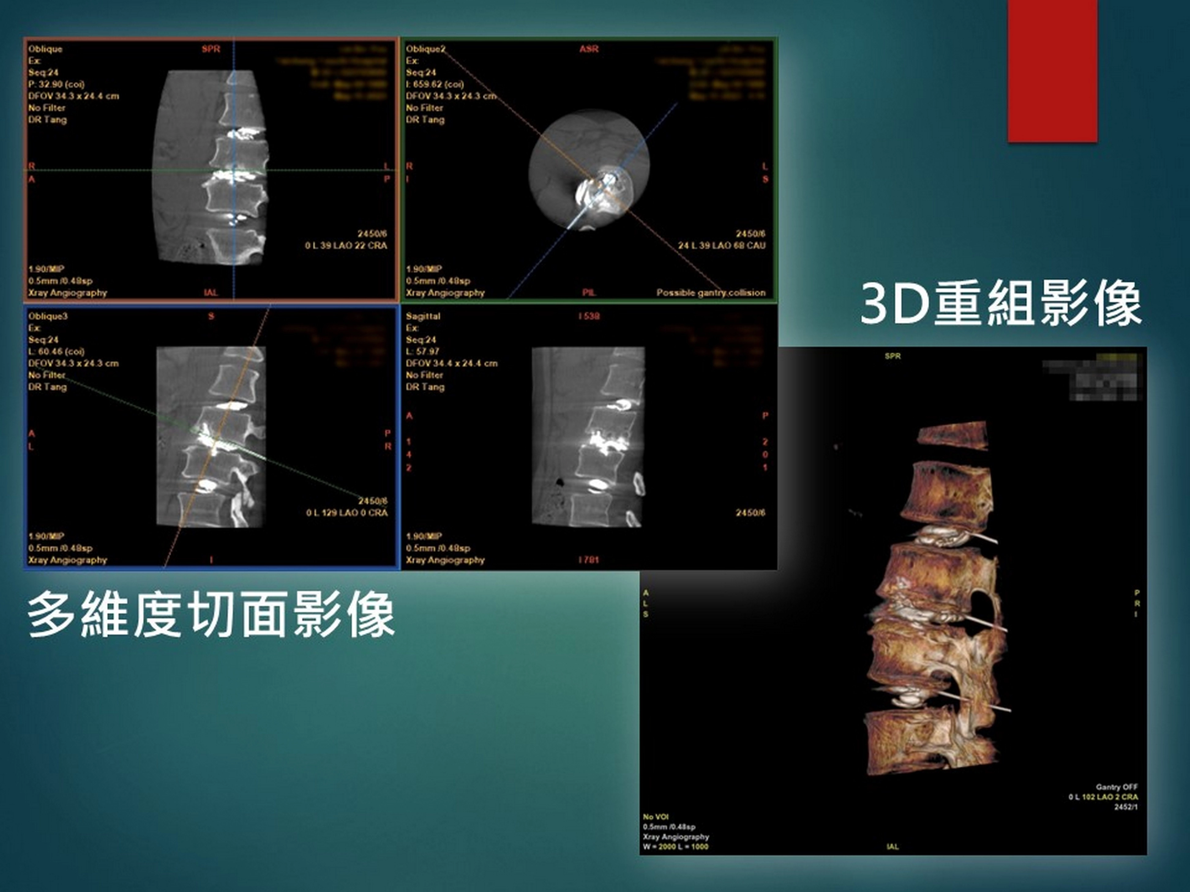 放射線多重影像導引設備可配合醫師需求，提供多維度切面影像以及3D重組影像精準導引治療位置。