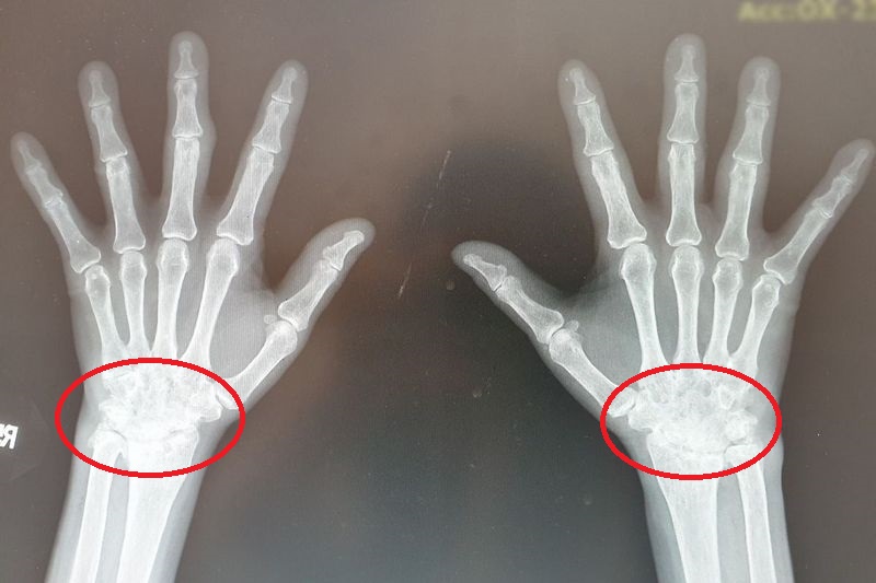 X光顯示病患的手腕因為類風溼性關節炎已經出現骨骼異常，腕骨融合、變形。