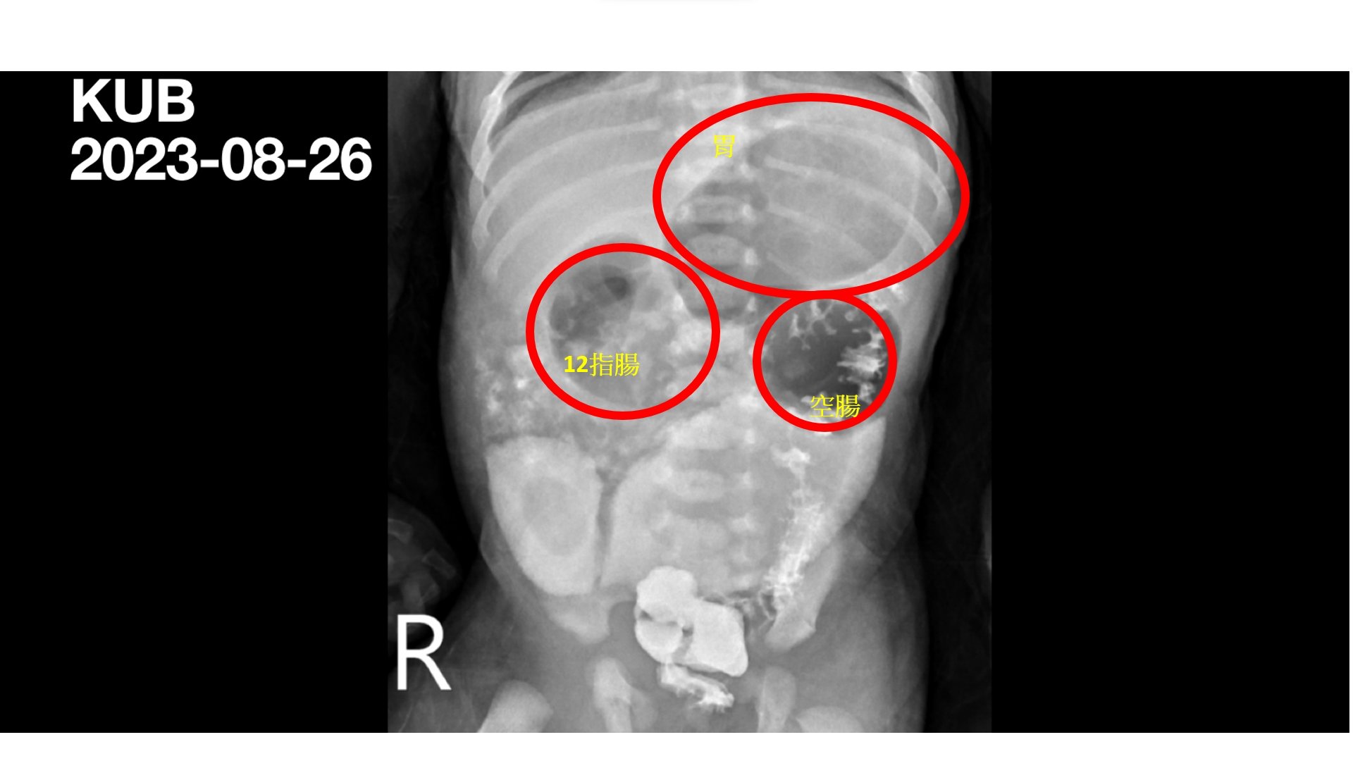 透過腹部X光攝影檢查，可以明顯看出腸道因為閉鎖造成的腸胃道腫大。