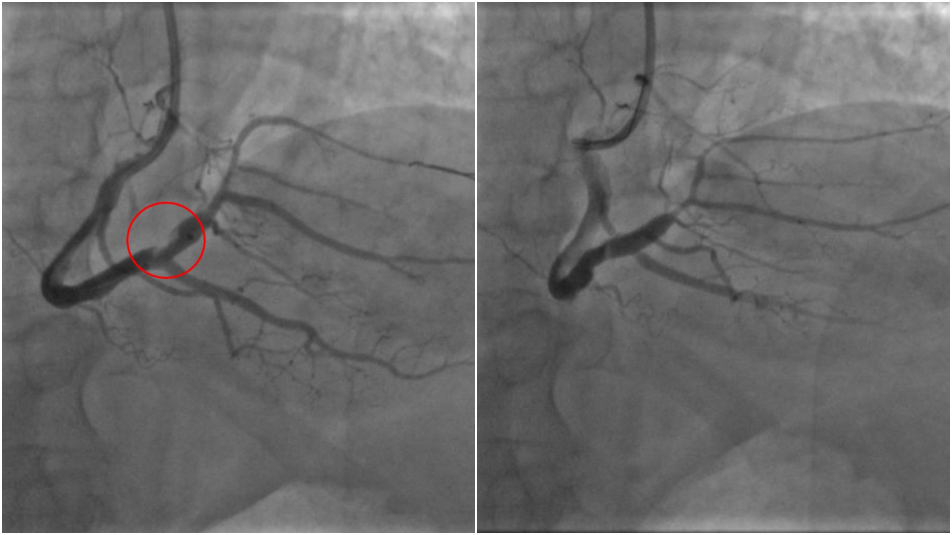 (左圖)抽出血栓後使原右冠狀動脈原發病灶清楚現形，得以精準置放支架，完成血管的暢通。(右圖)置放支架後恢復通暢的血管主幹。