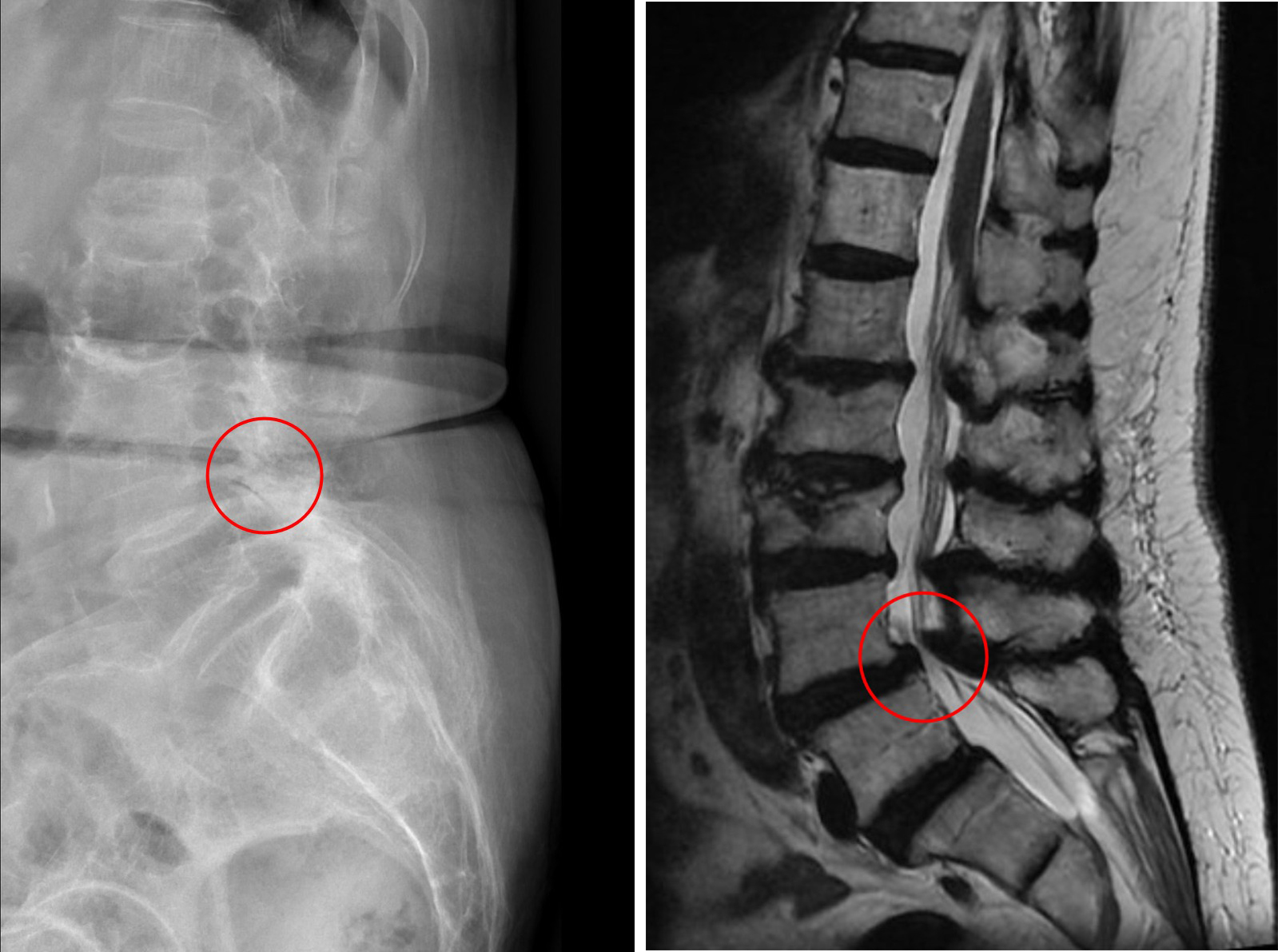 （圖左）經X光檢查發現郭奶奶腰椎滑脫。（圖右）磁振造影顯示腰椎滑脫後因骨刺壓迫造成神經狹窄。