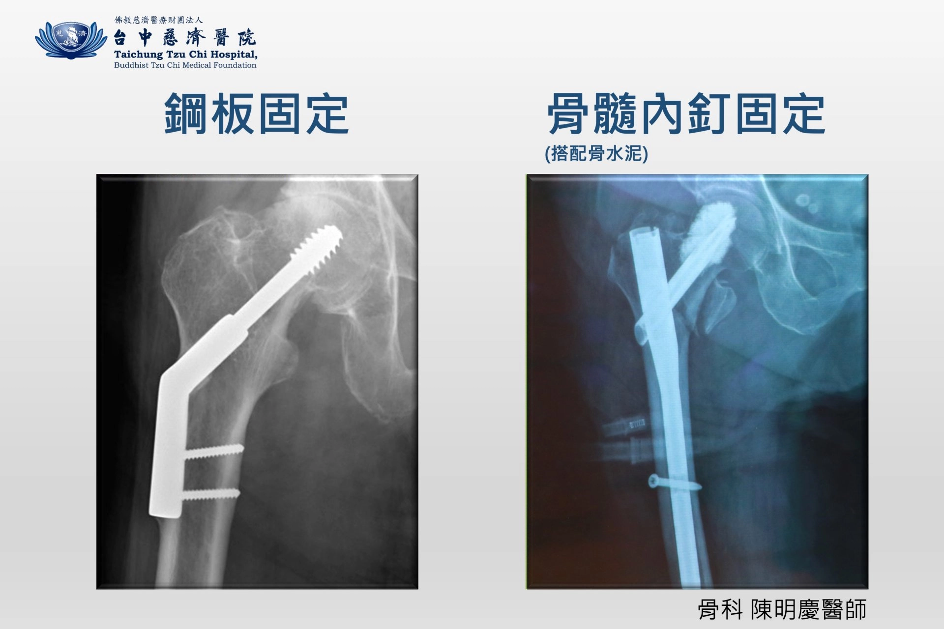 鋼板與骨髓內釘固定Ｘ光片對照。