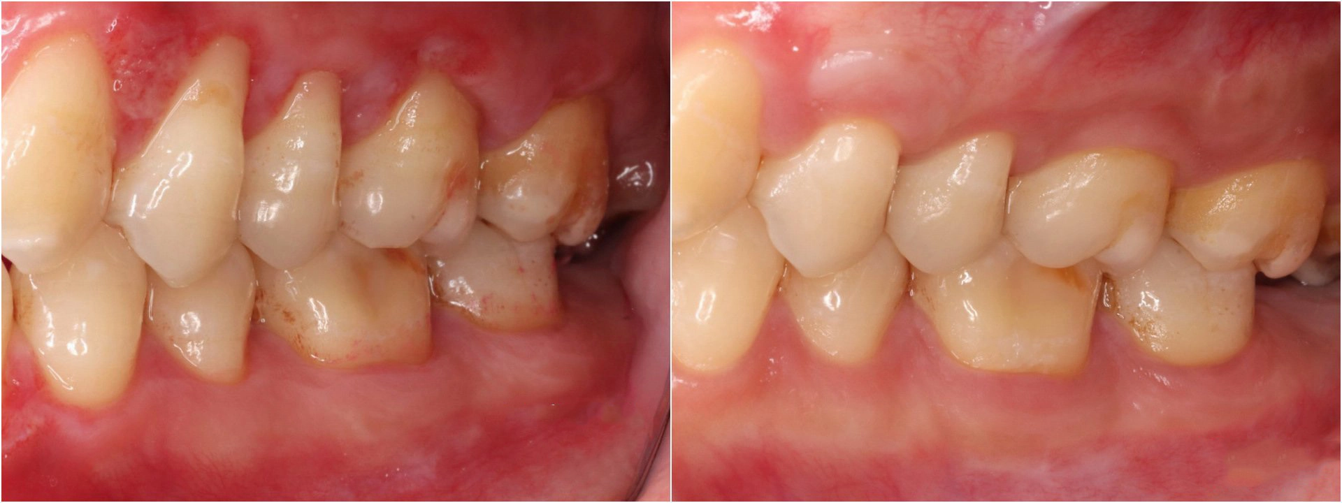 術前因牙齦退縮，牙齒明顯變長(左圖)；透過「皮下結締組織移植術」執行牙根覆蓋手術，牙齦長回正常的厚度、高度。(右圖)