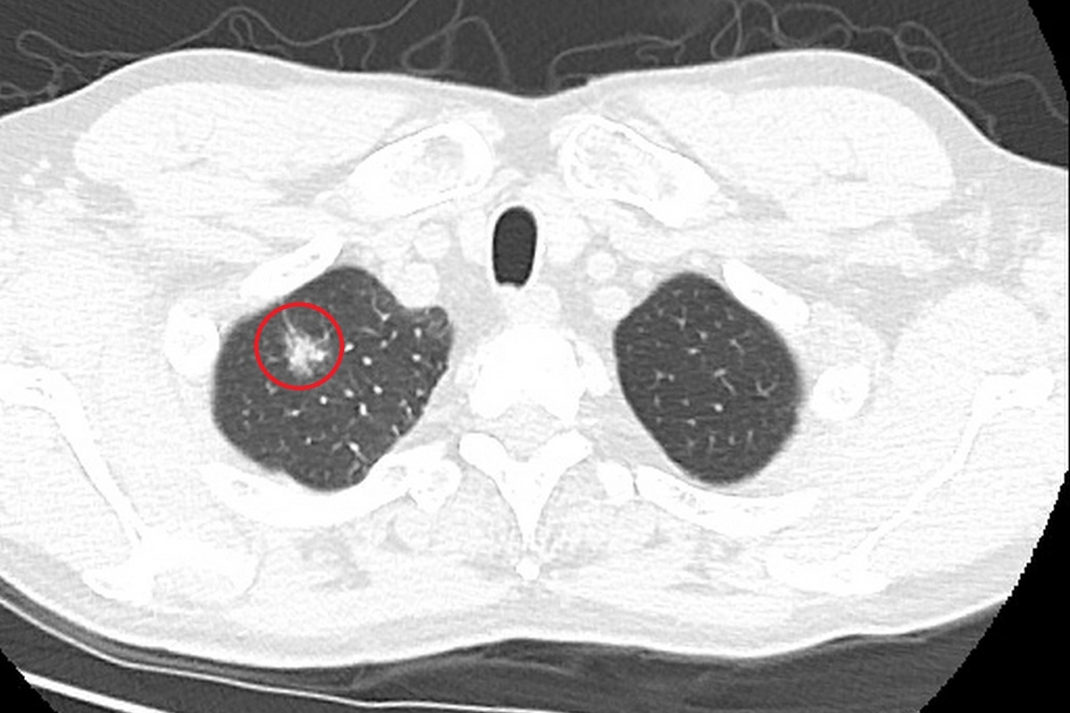 電腦斷層顯示，右側右上肺葉出現1.7公分大腫瘤。