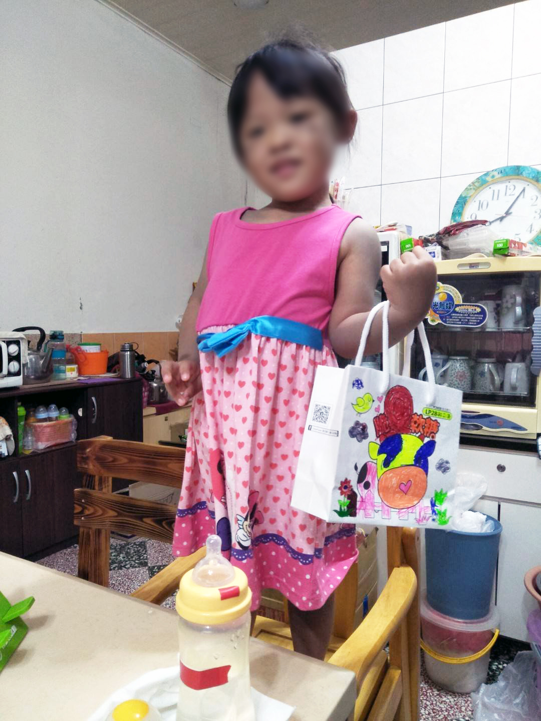 小真出生從小腿以上都是紫青色胎記