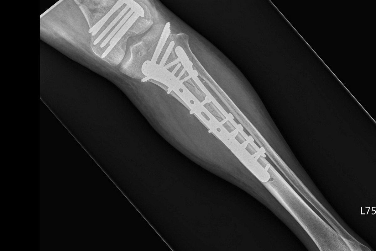 「開放性復位及內固定手術」即是將骨頭復位至正確位置後，再以骨板及骨釘固定斷骨，此圖為患者左側小腿髕骨與脛骨處。(圖/台北慈濟醫院)