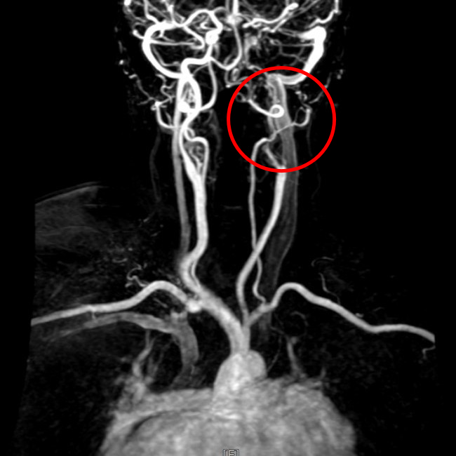 經核磁共振檢查發現缺少左側內頸動脈的顯影，顯示左側內頸動脈完全阻塞。