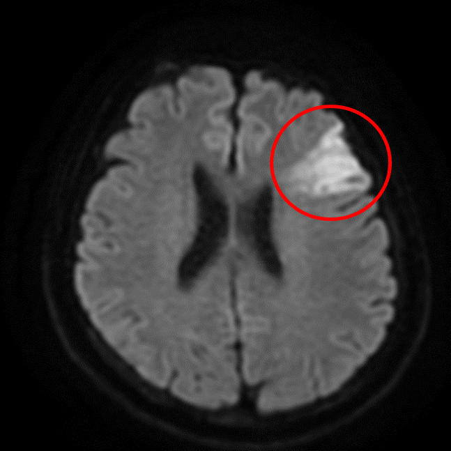 核磁共振影像顯示左腦有明顯發亮區域，確認為腦腦塞。