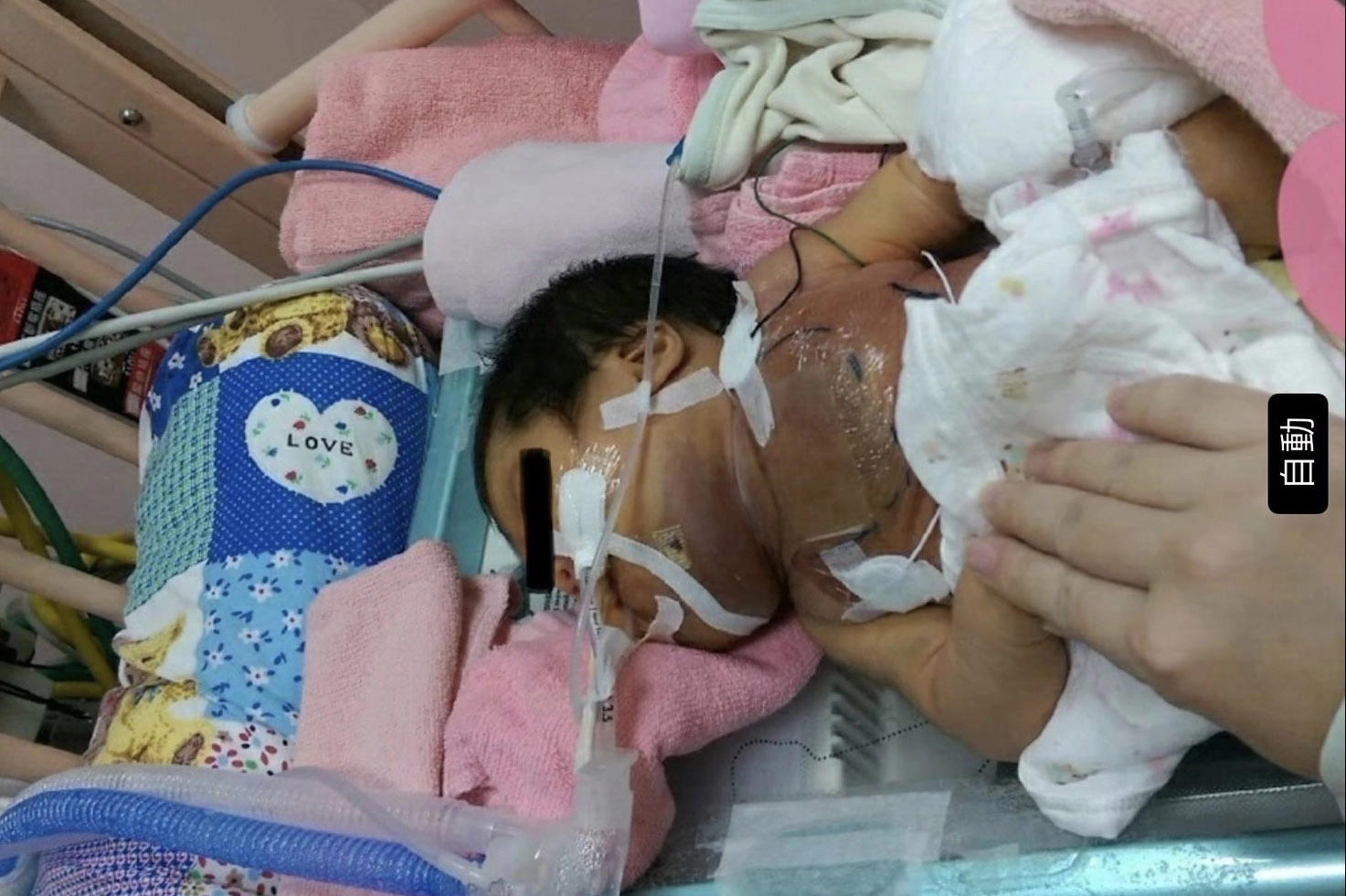 小琪出生即因血管瘤增生住進加護病房 與死神搏鬥