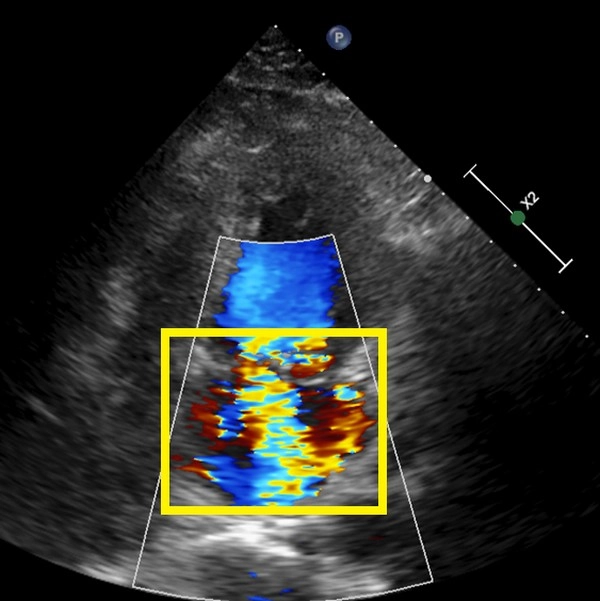 超音波顯像中看到逆流的血液(黃框處)。