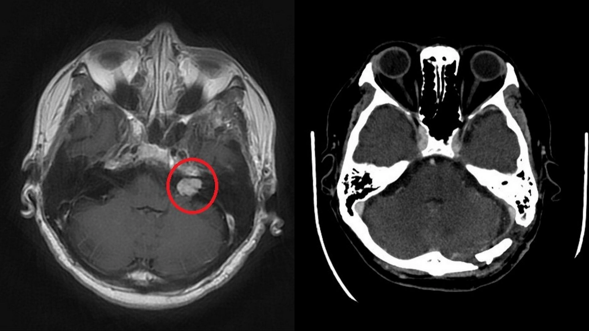 術前核磁共振顯示紅圈處有一小於2公分大的腫瘤(左)；術後電腦斷層可以確認腫瘤已完整取出(右)。