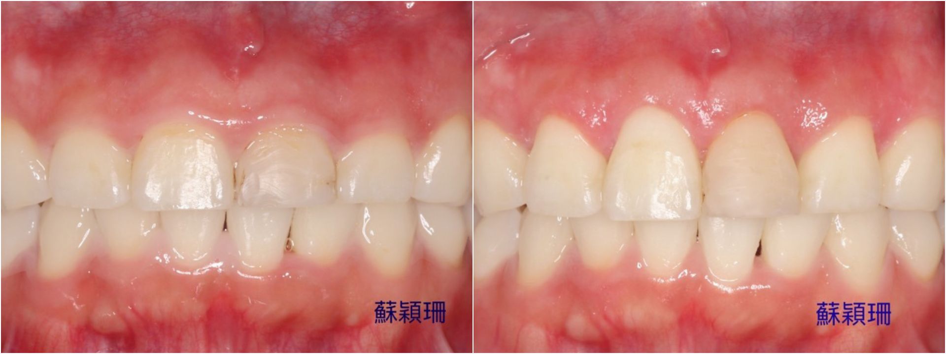 病人因為變異被動性萌發導致牙冠過短(左)；經過牙冠增長術提升美觀與自信（右）。