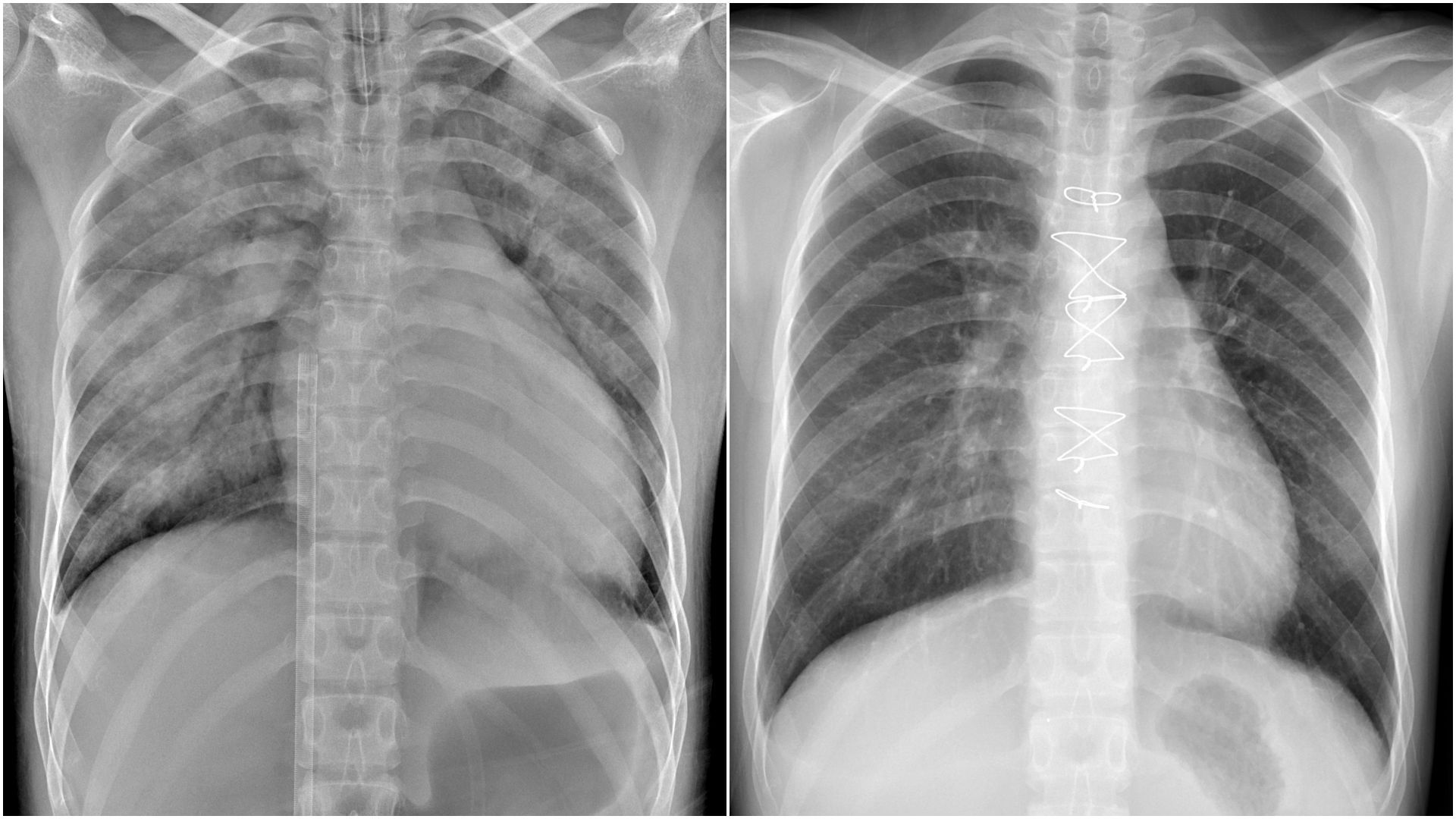 （左圖）鄭小姐裝上葉克膜六小時後，胸腔X光影像中肺部幾乎呈白色，肺水腫嚴重且心臟明顯擴大。（右圖）鄭小姐出院後第二次回診檢查，胸部X光影像顯示肺部與心臟已恢復正常。