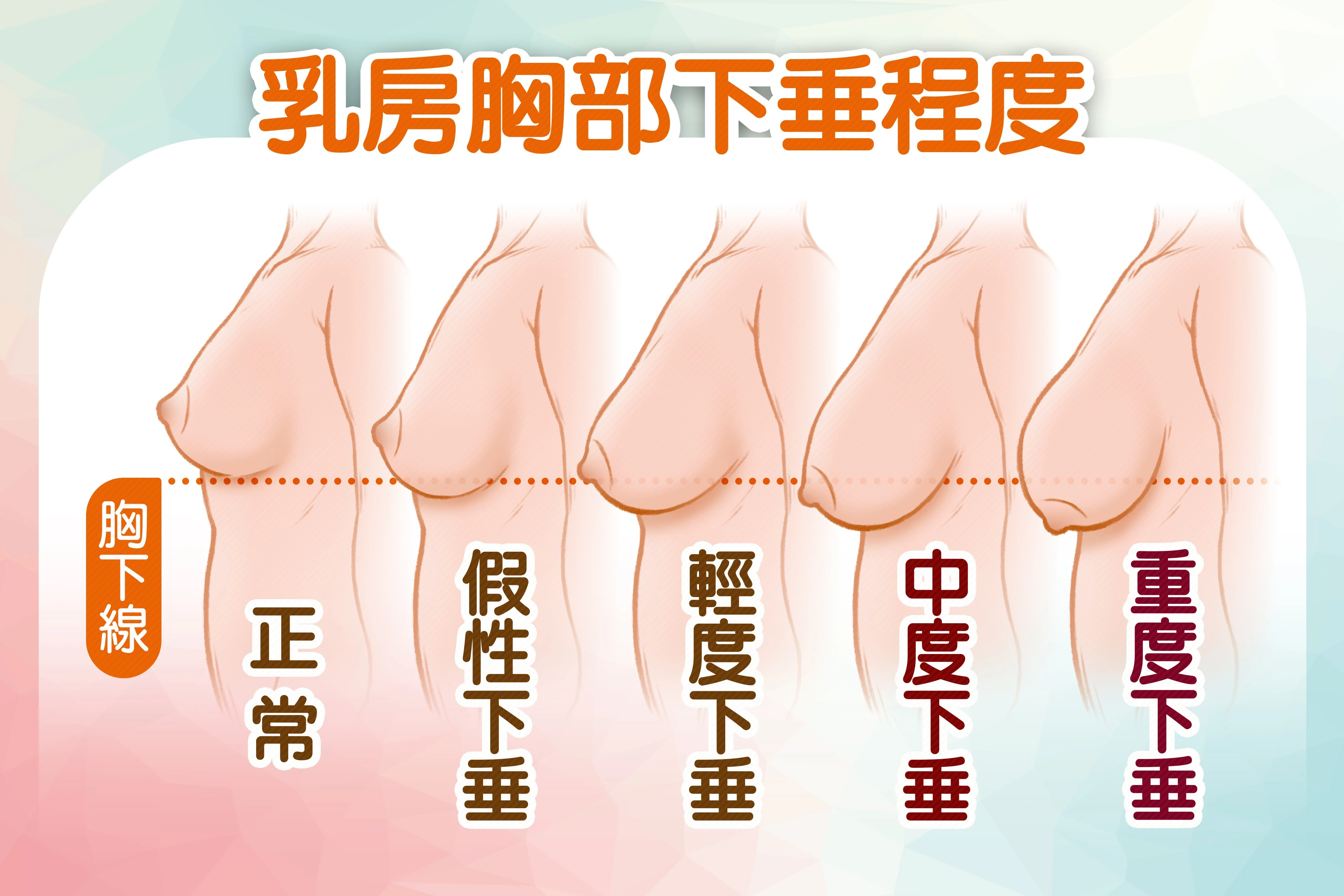 女性乳房下垂程度，可以藉由乳頭或乳暈相對於乳房下緣線的位置，來判斷下垂程度。