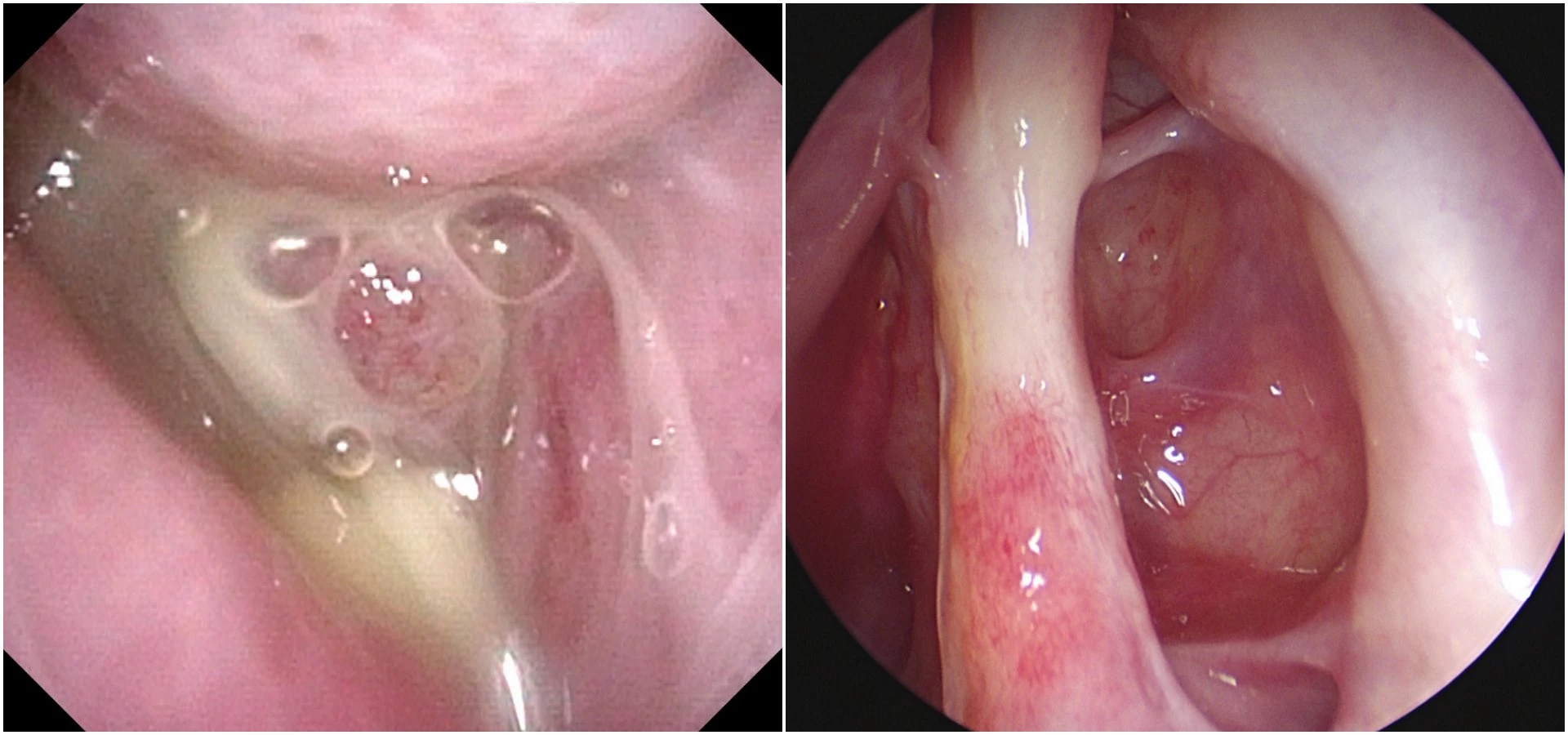 手術前鼻腔許多黃綠色帶膿的鼻涕(左)；手術後鼻腔恢復乾淨、通暢(右)