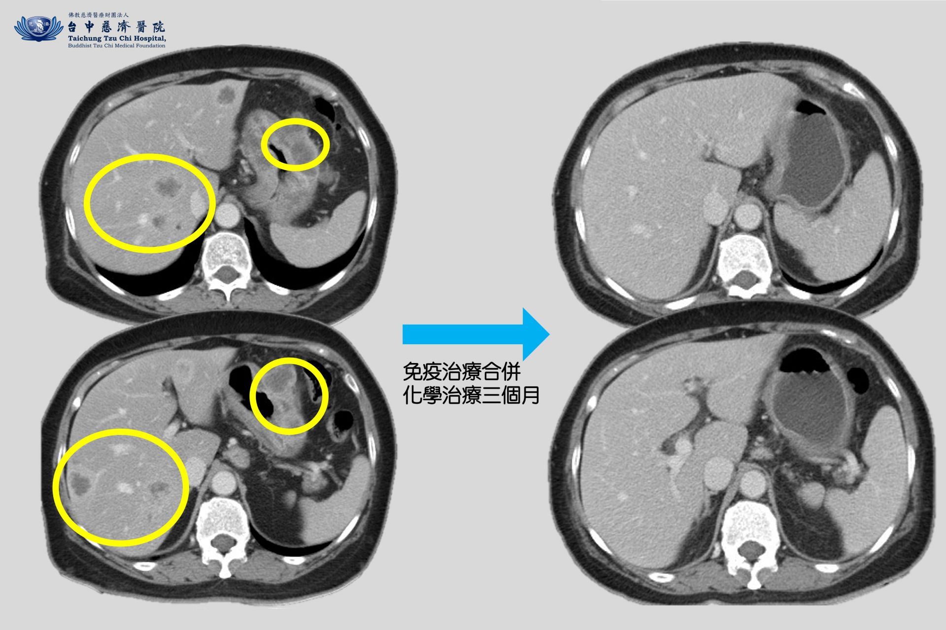 免疫治療合併化學治療三個月前後比對。