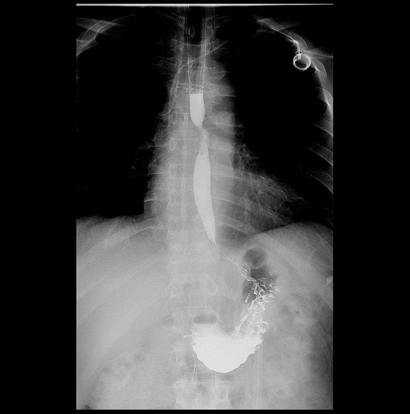 圖為55歲食道癌患者，放化療後，上消化道以鋇劑X光攝影，已無黏膜皺襞破壞、管壁僵硬，管腔狹窄，鋇劑通過受阻等症狀。