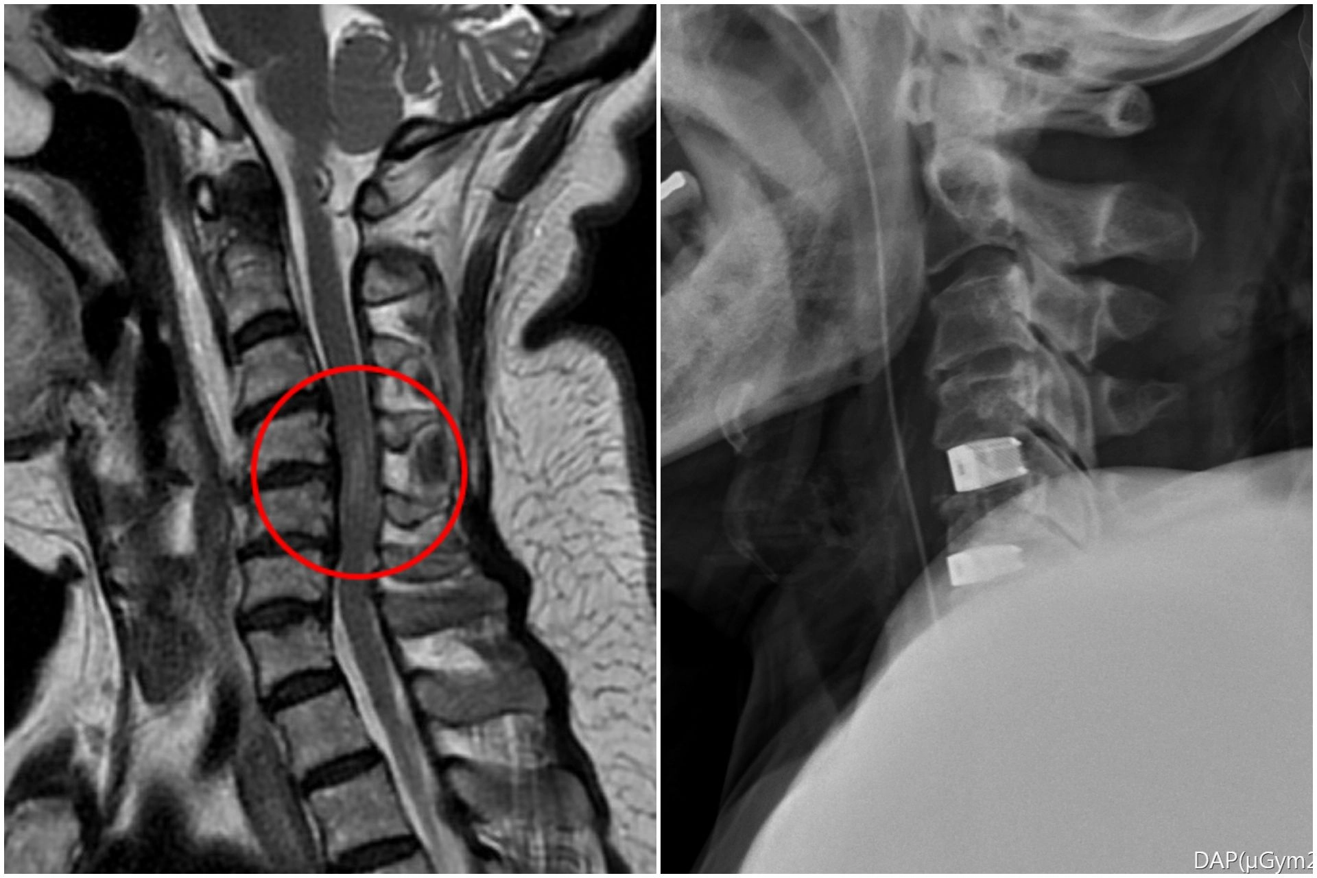 （左圖）磁振造影檢查結果顯示，72歲徐姓婦人頸椎第四到六節的神經被壓迫，且已造成脊髓損傷。（右圖）李建輝醫師以脊椎內固及融合微創手術，清除突出的椎間盤後放入填充物，並用支架固定頸椎。