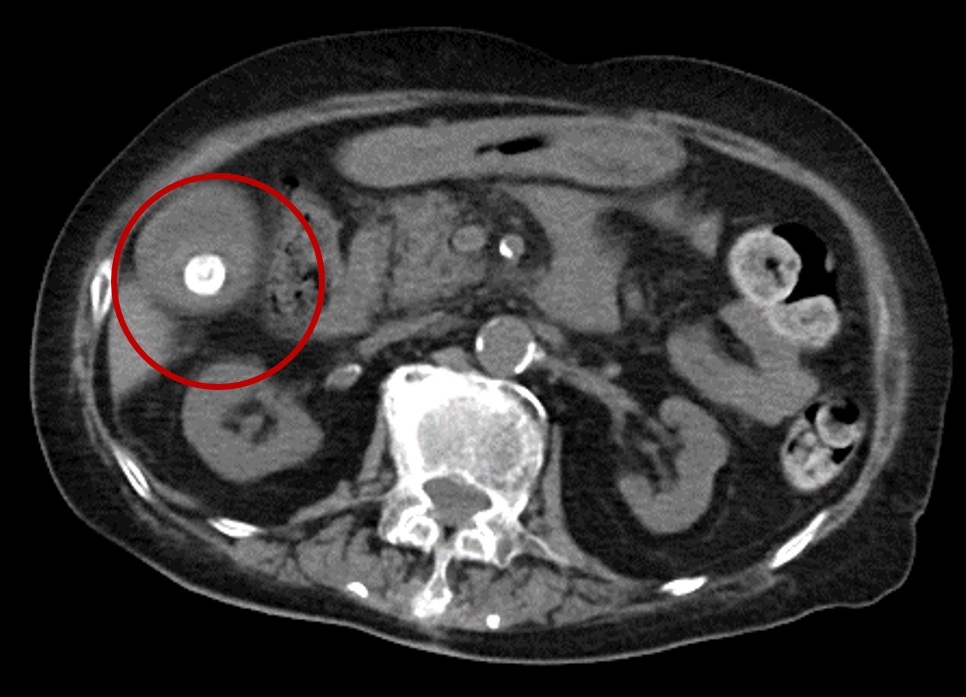 電腦斷層顯示紅圈處內的白色部分為膽結石。