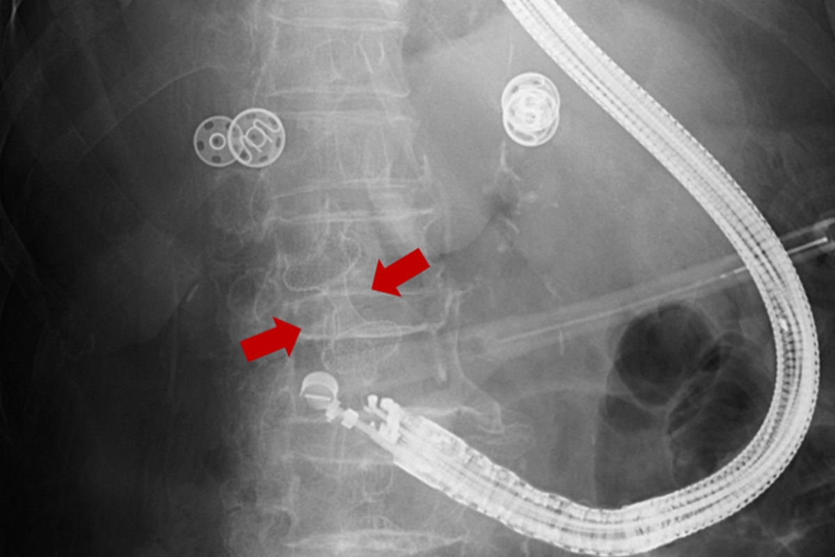 箭頭處所指為置於膽囊與十二指腸球部之間的金屬支架。