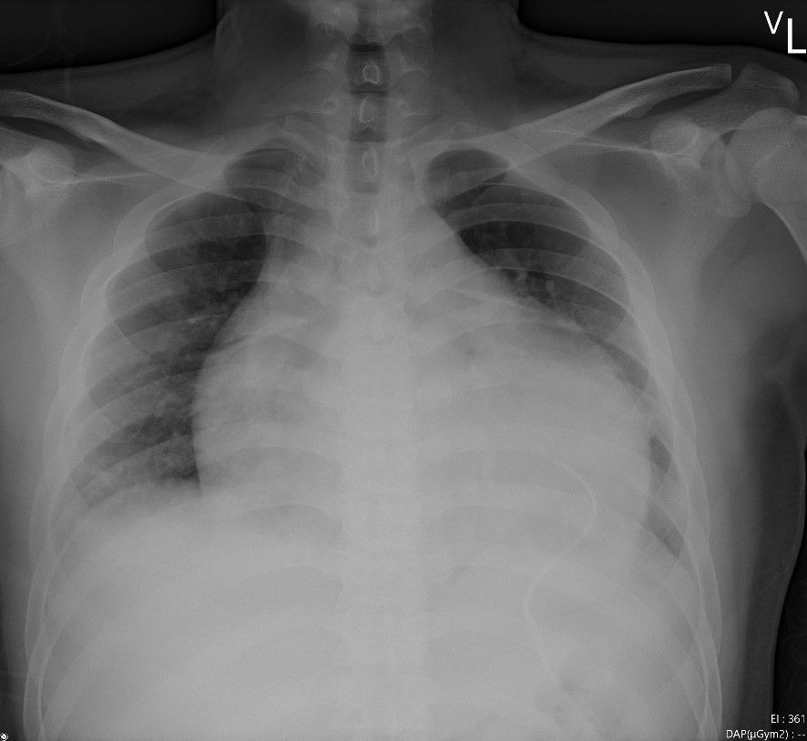 胸部X光可見心臟嚴重擴大，放置引流管減少積水，並以支持式療法治療，數日後才逐漸改善，最後病患順利出院。