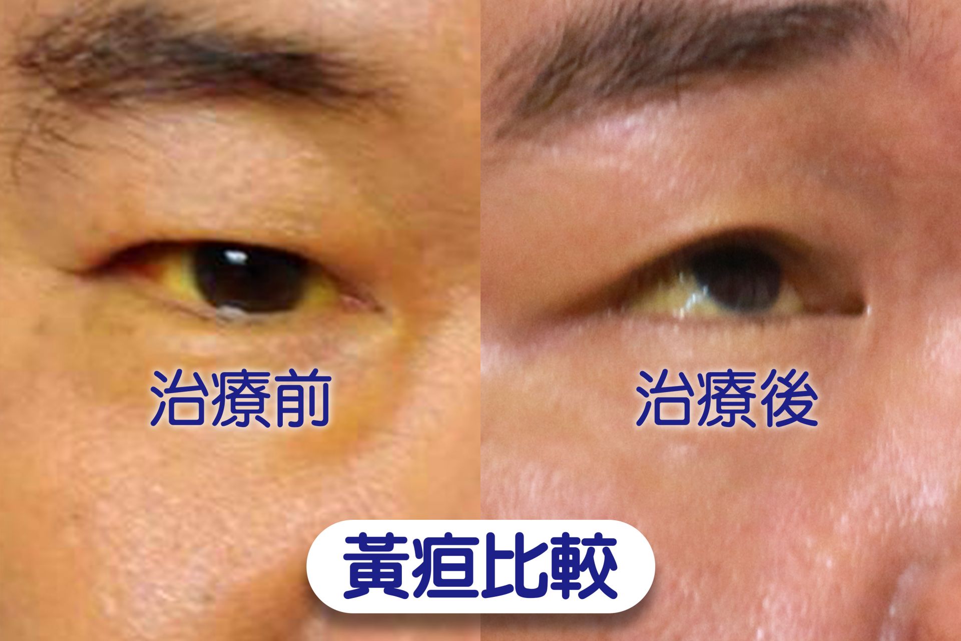 林先生治療接近兩周，黃疸症狀逐漸消退，但眼白依然看得到黃色。