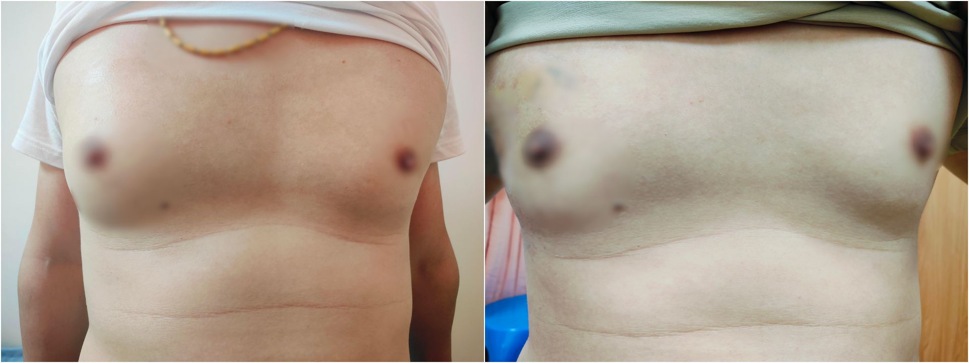 （左圖）吳柏鋼醫師說，病人術前照片，他的右側乳房明顯腫大。（右圖）病人回診，右側乳房已明顯消腫。
