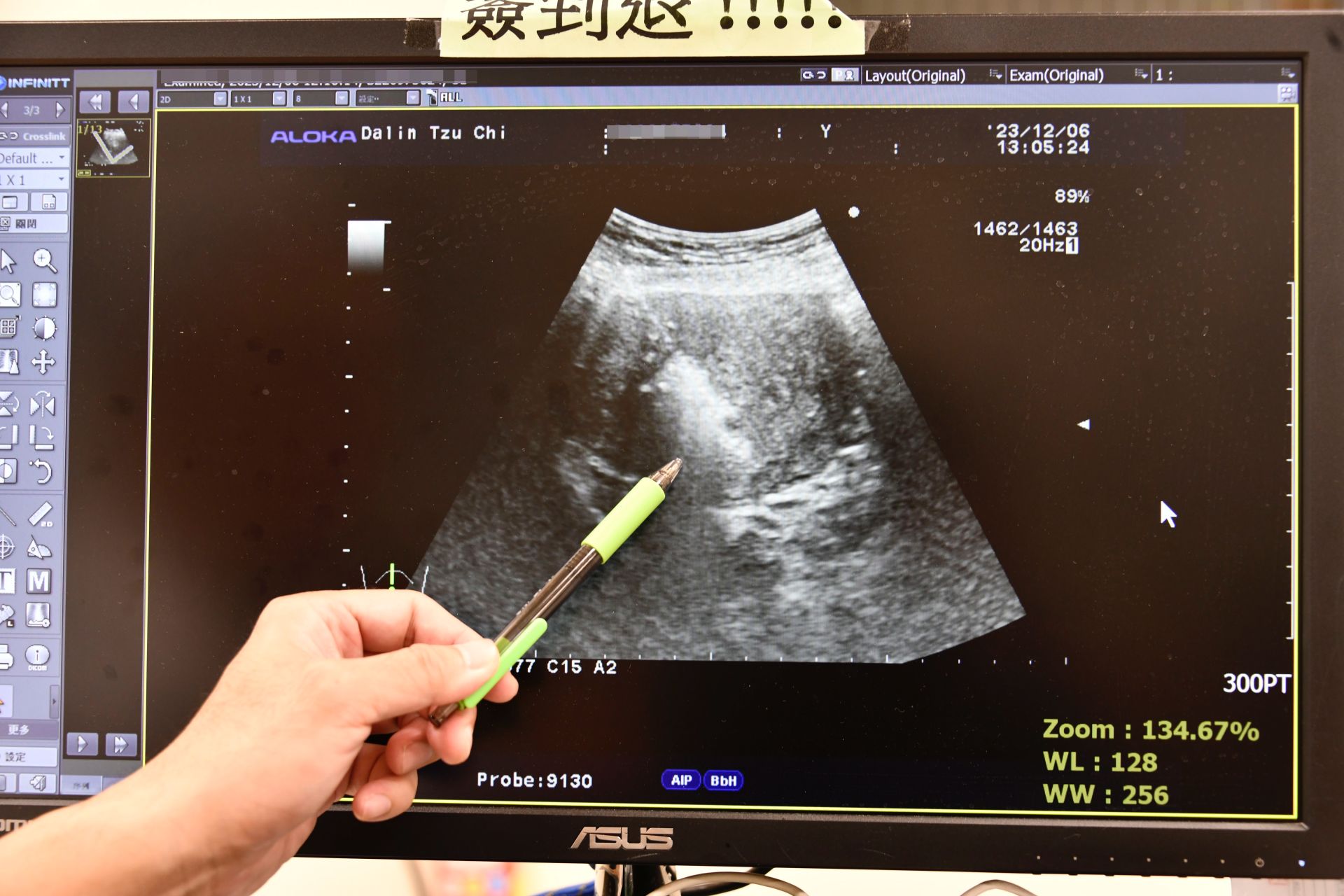 超音波檢查影像可看出正在進行消融破壞腺肌瘤