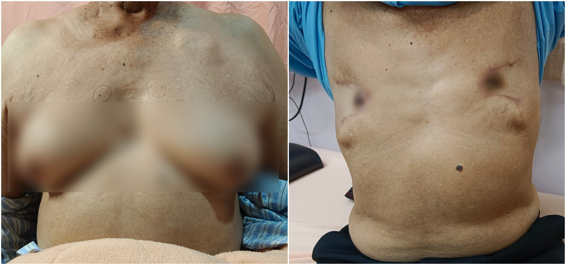 （左圖）年近八旬病人，兩側乳房疼痛約一個月，到花蓮慈濟醫院乳房醫學中心吳柏鋼醫師門診，經檢查診斷為第四級「男性女乳症（Gynecomastia）」。<br/>（右圖）病人手術切除後恢復身材，男性女乳症是男性常見的乳房問題，建議男性朋友一旦出現類似症狀時，可到花蓮慈院乳房醫學中心門診檢查，早期診斷早期治療。