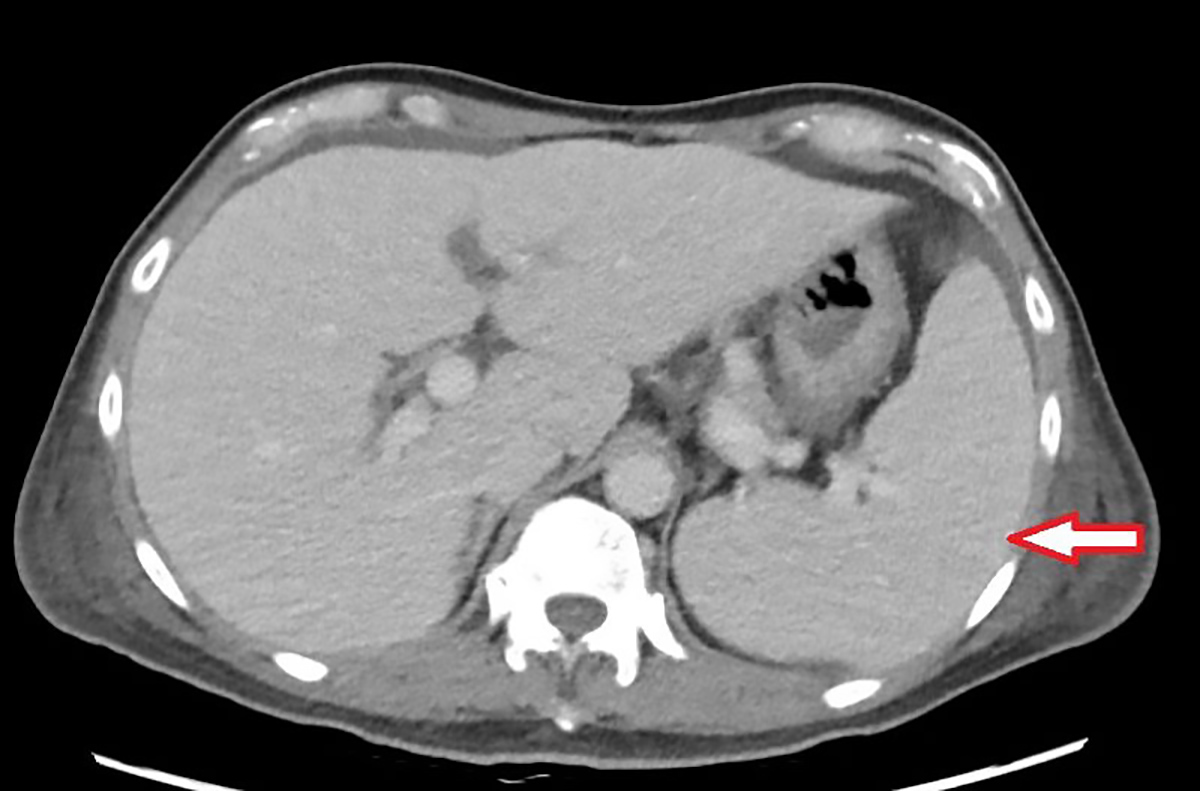 電腦斷層發現脾臟腫大。