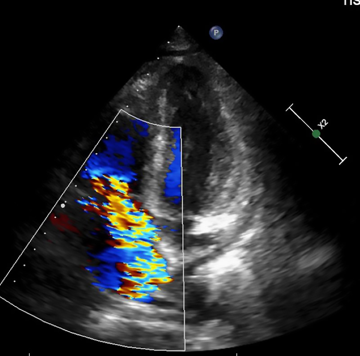 影像檢查發現三尖瓣逆流。