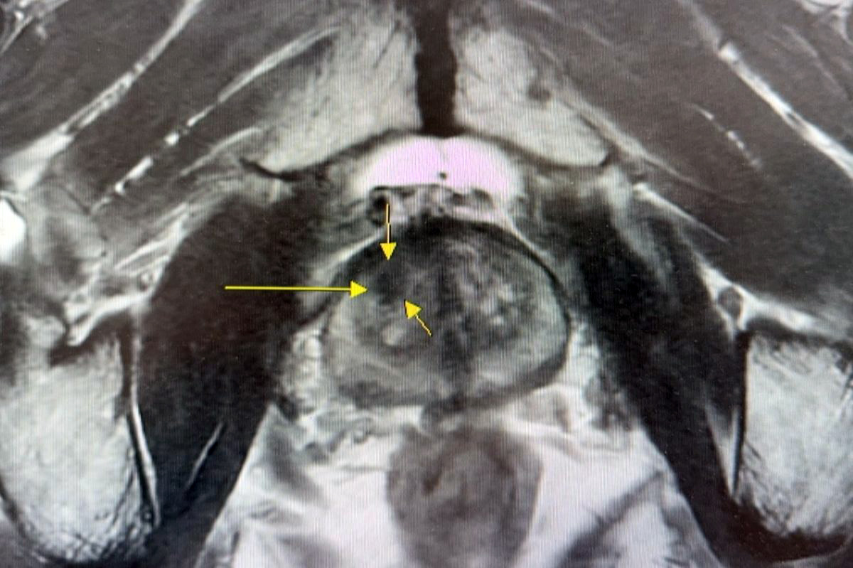 透過核磁造影與超音波影像融合攝護腺切片檢查，精準判斷腫瘤位置。