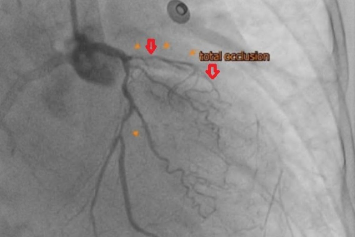 心導管檢查發現其左前降支完全阻塞以及左迴旋枝的狹窄。