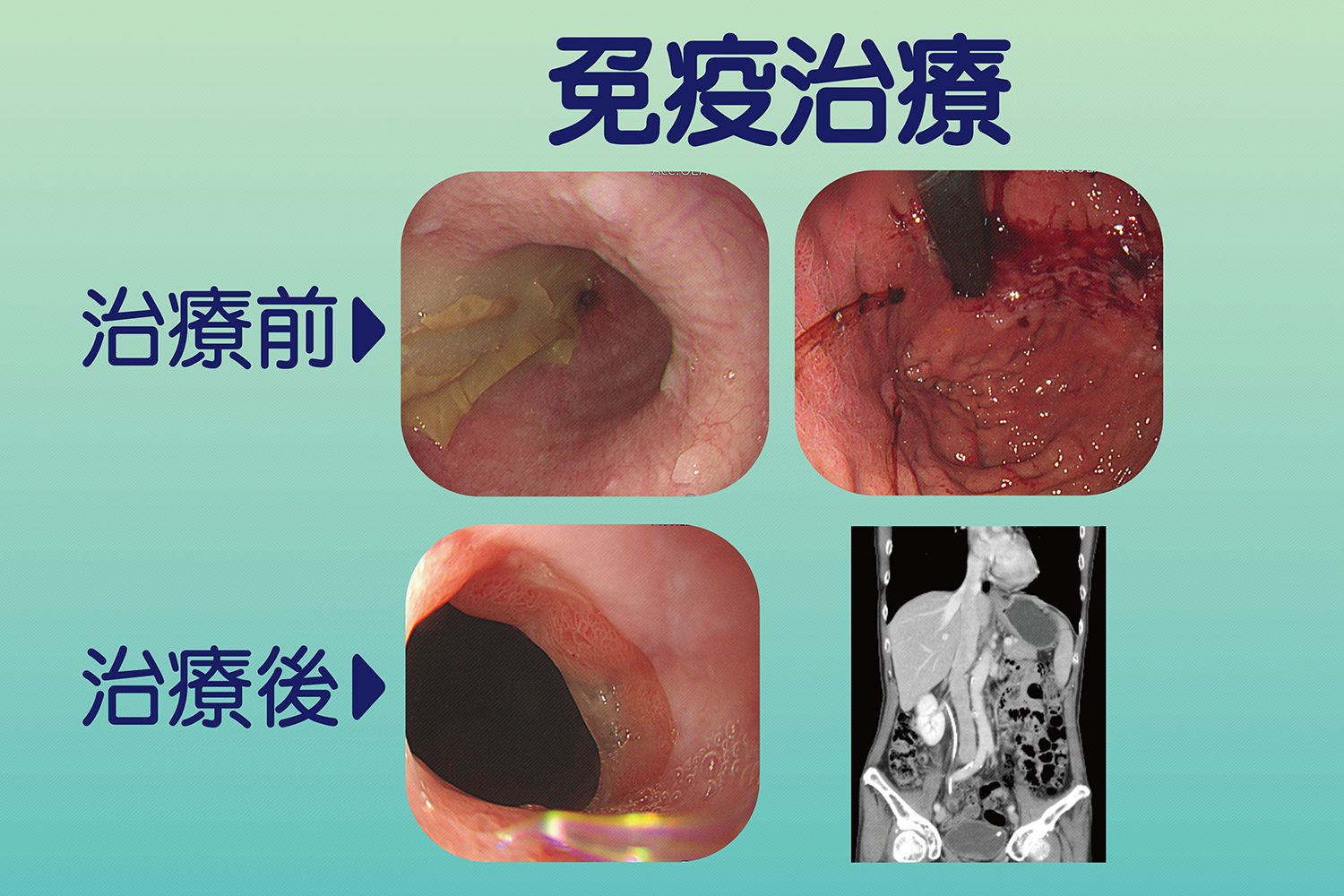 病人接受免疫治療前後比照，腫瘤明顯縮小，阻塞症狀得到緩解。
