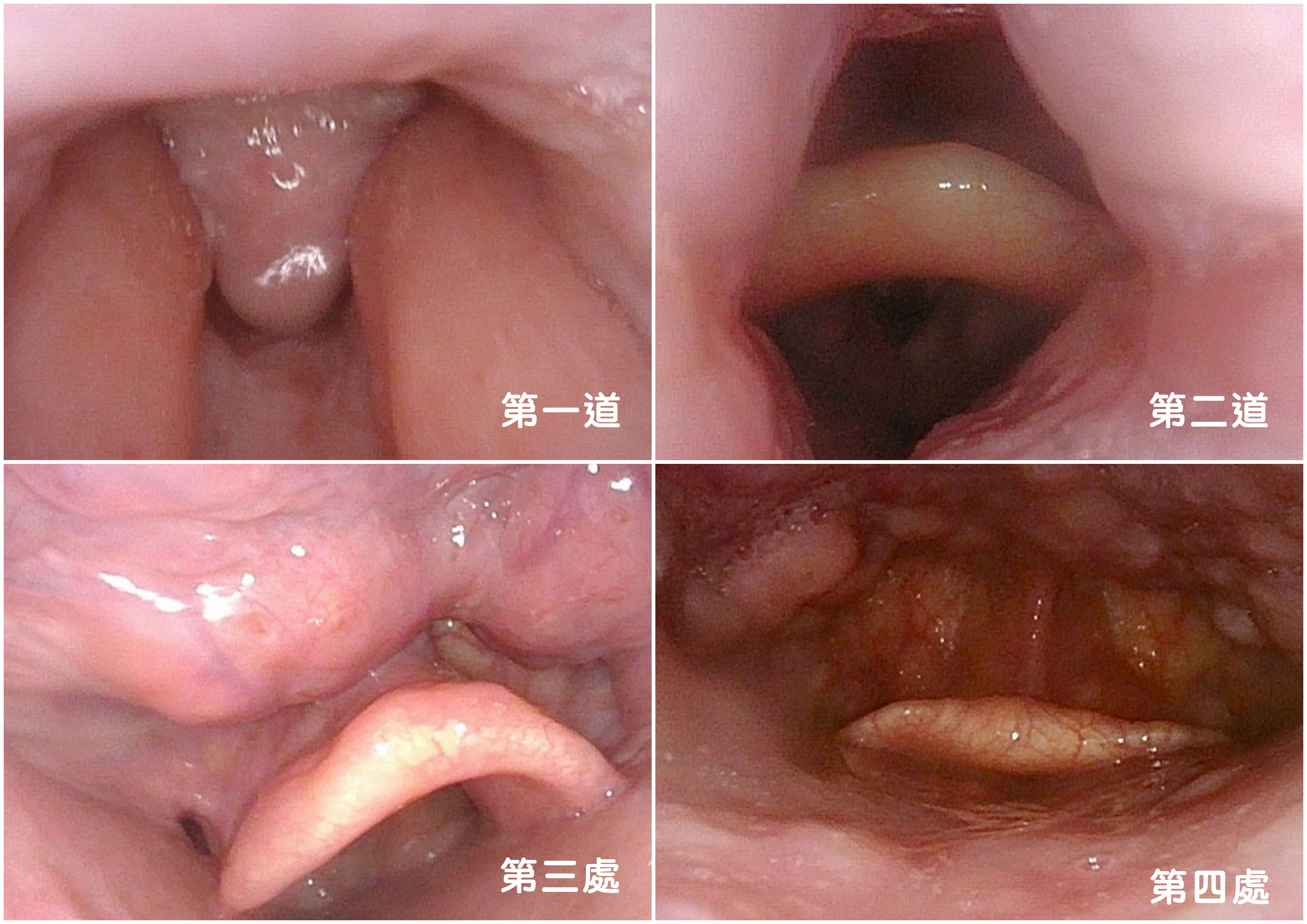 透過內視鏡可看到氣體進入第一道至第四處。