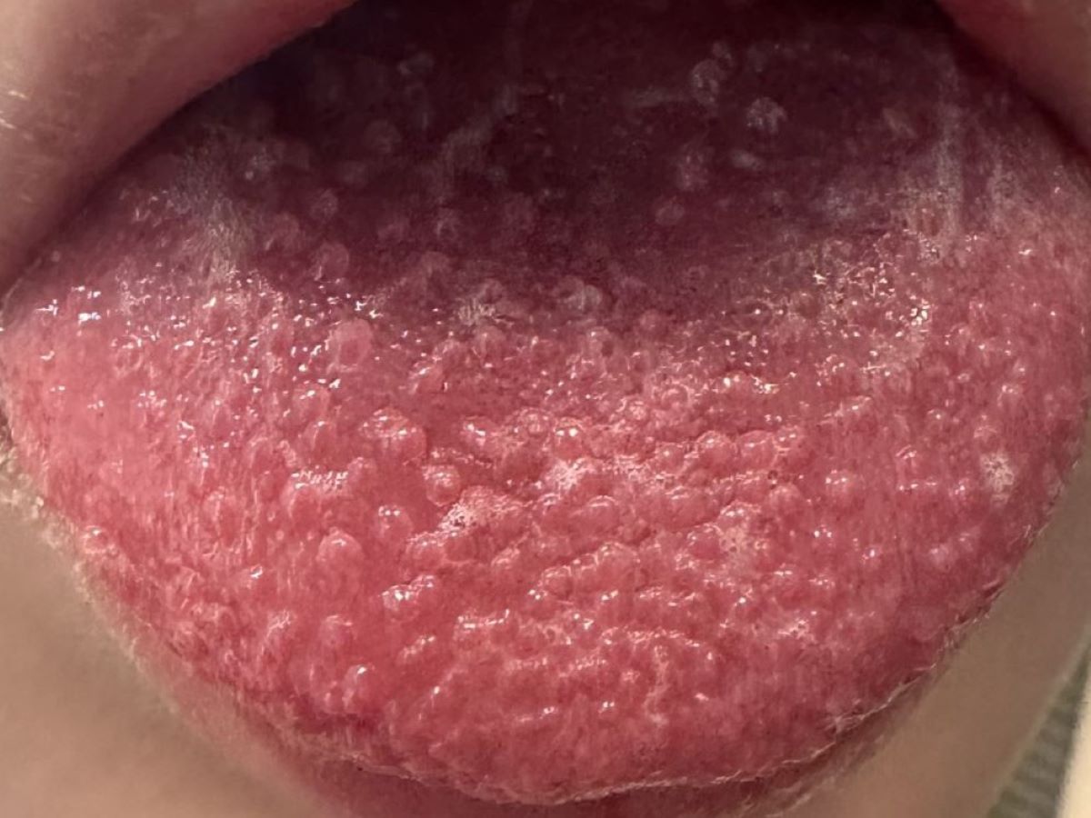 病人出現典型的草莓舌。