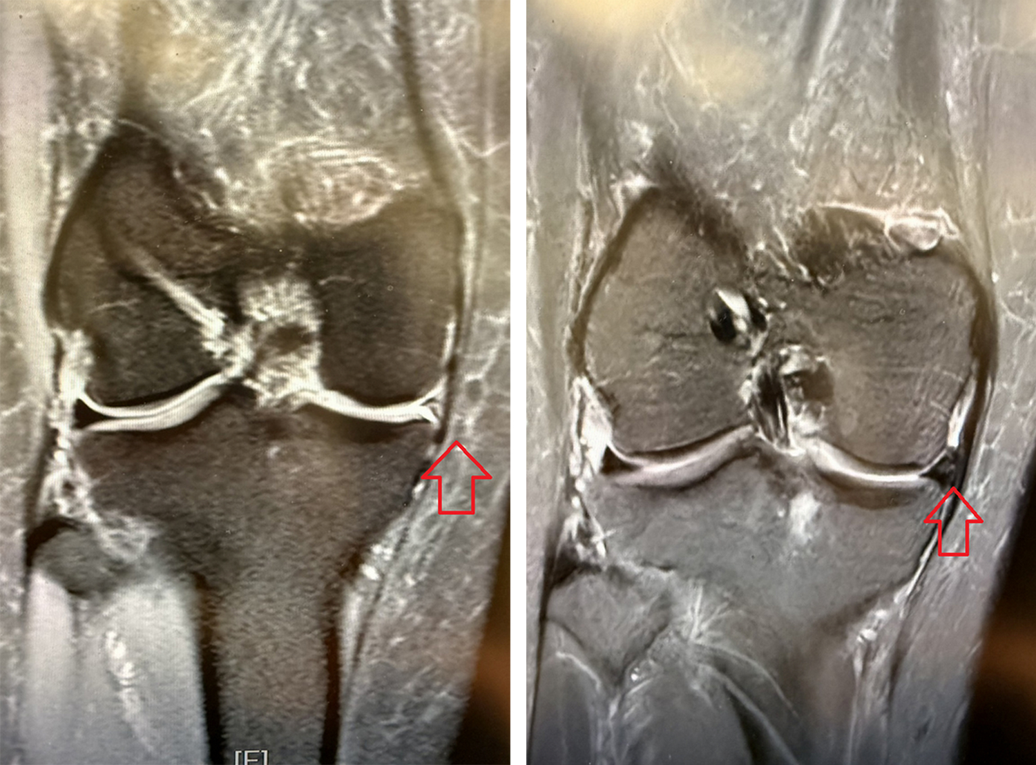 手術前，核磁造影檢查發現半月軟骨不見蹤跡(左)；手術後半年，可見移植的半月軟骨(右)。