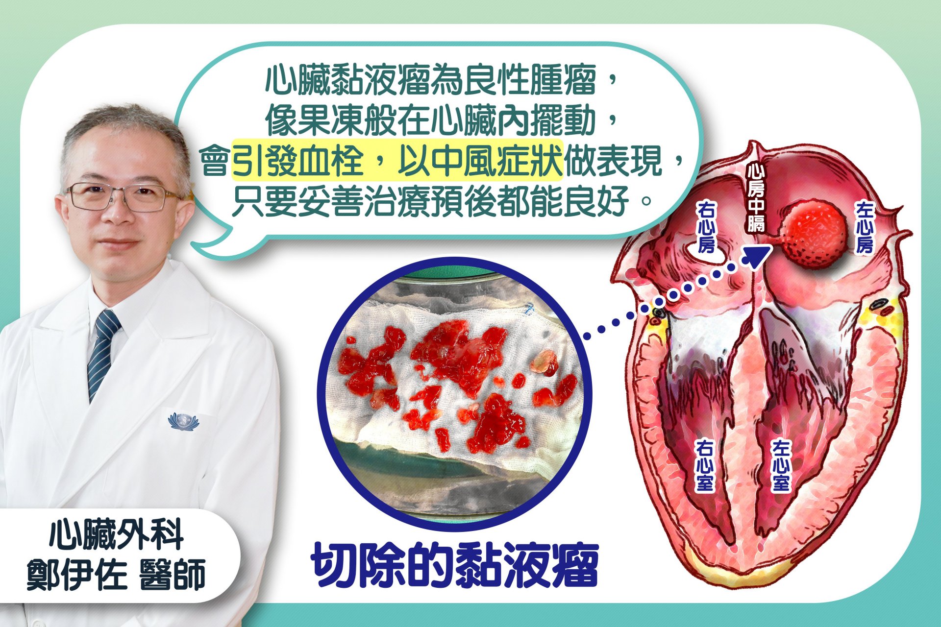 鄭伊佐醫師說明，心臟黏液瘤為良性腫瘤，像果凍般在心臟內擺動，會引發血栓，以中風症狀做表現，只要妥善治療預後都能良好。