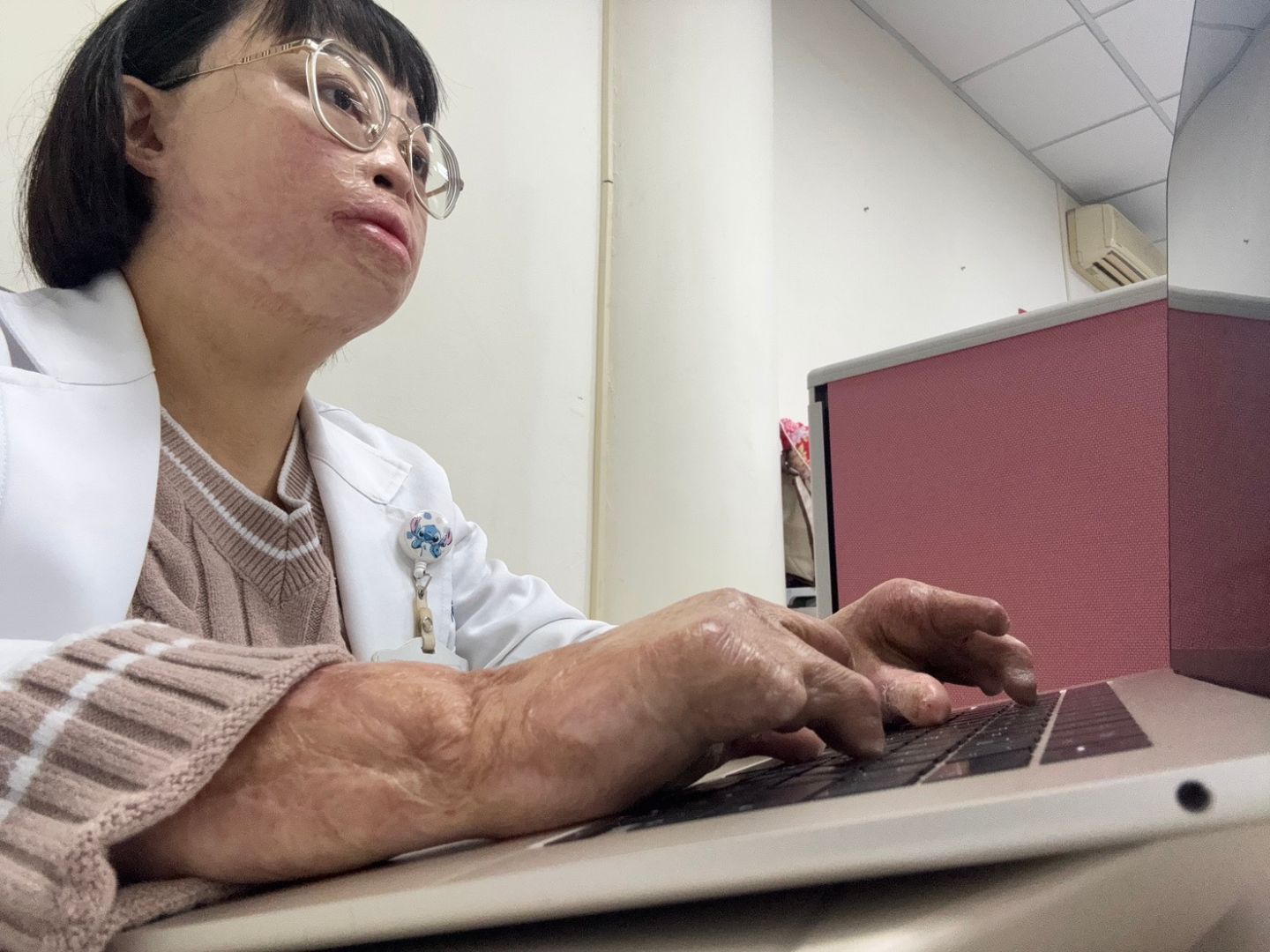 嚴重燒傷的承怡今已成為一名社工師