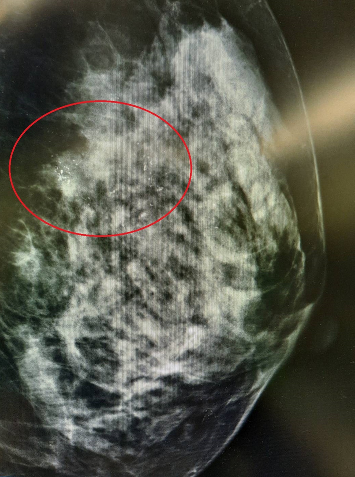 乳房攝影檢查發現右側有瀰漫性微小鈣化點。