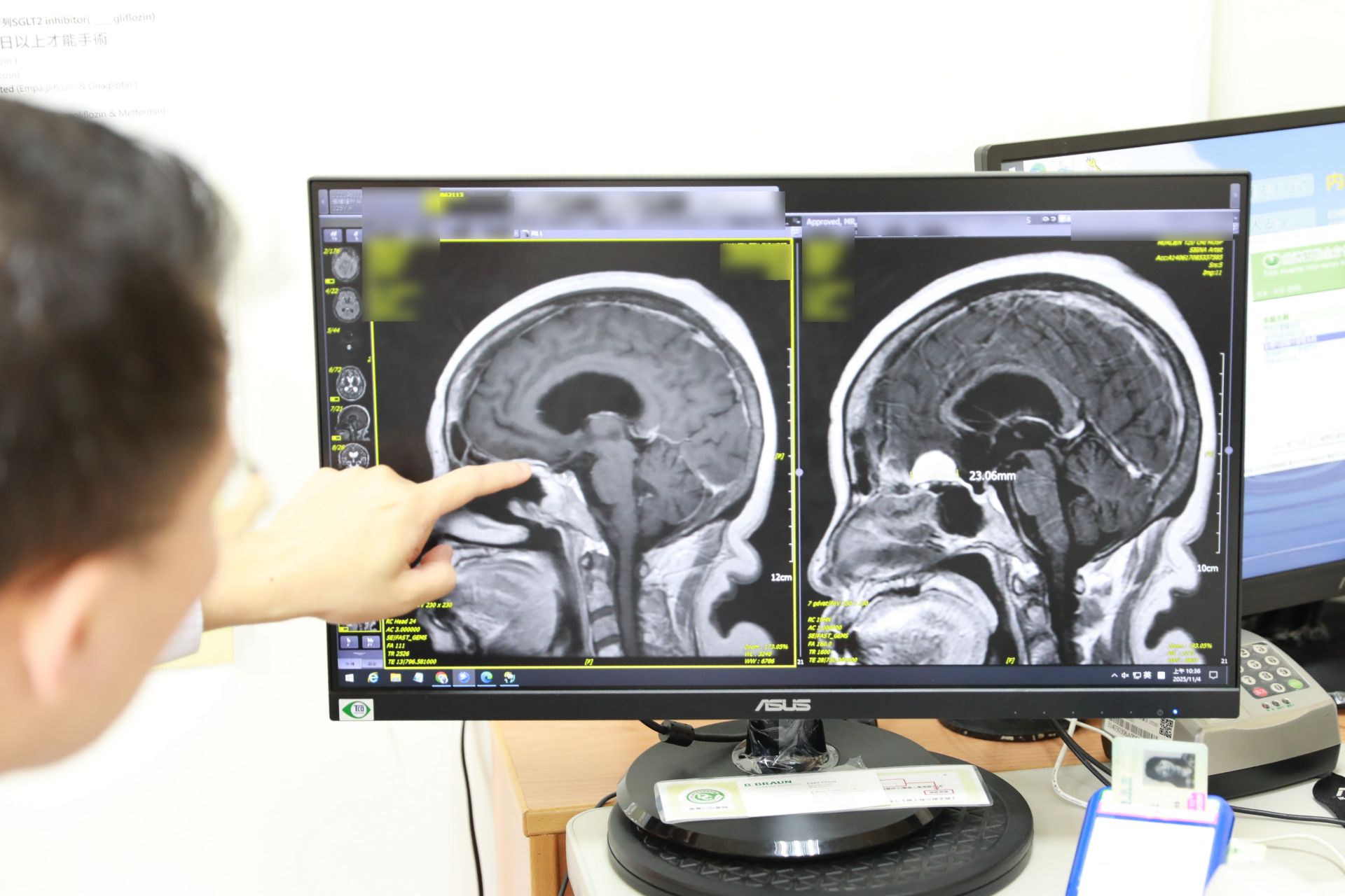 阿琴姊的術前術後影像對照。右側為術前可以看到顱底呈現白色影像將近3公分的腦瘤，直接堵住腦脊髓液的循環路線，造成堰塞湖效應腦室積水，左側影像可對照看出術後腦瘤已清除乾淨。