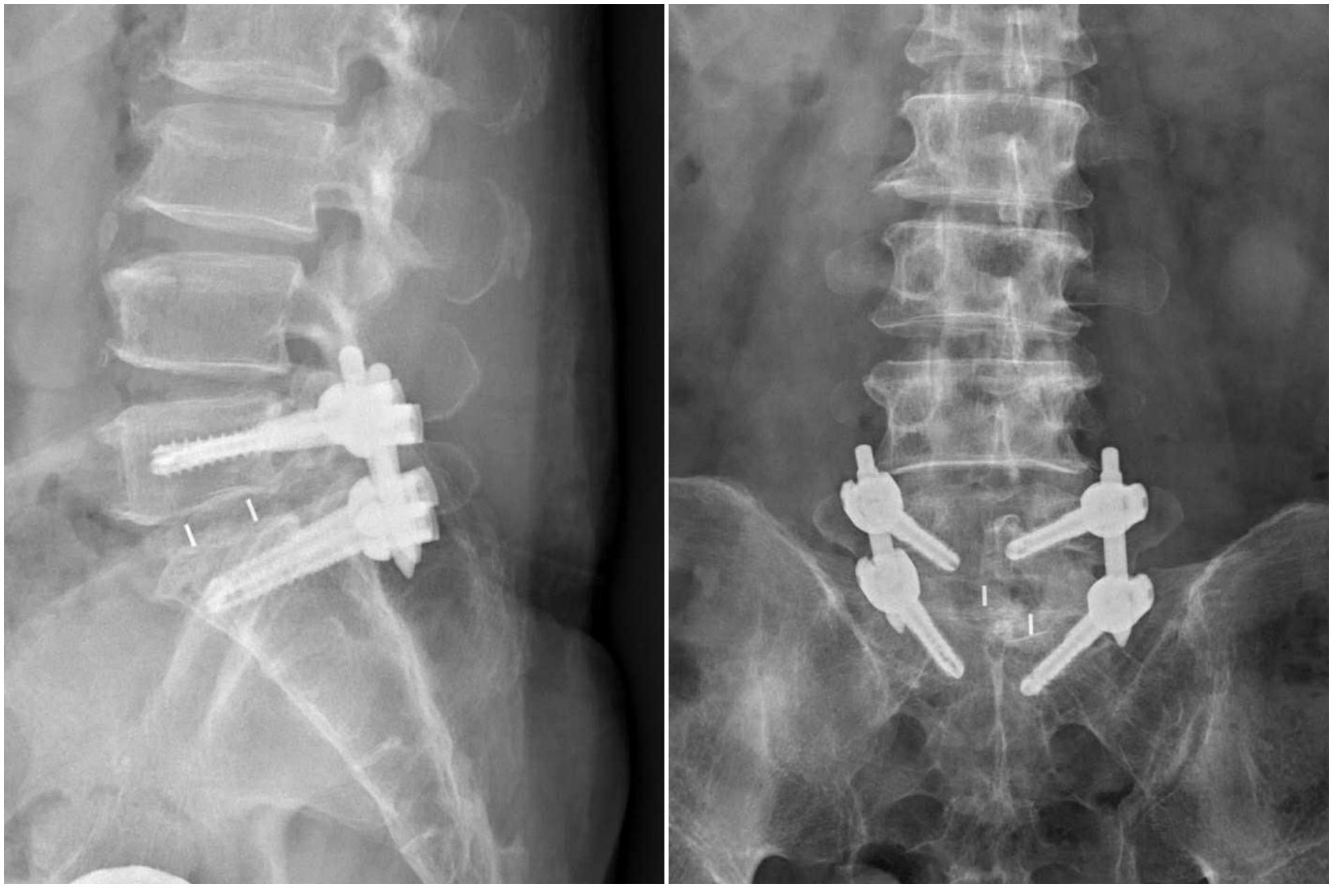 洪祥益主任與團隊透過顯微鏡,在不傷及神經的情況下,仔細將痛風石刮除清理,再以微創固定融合手術完成治療。