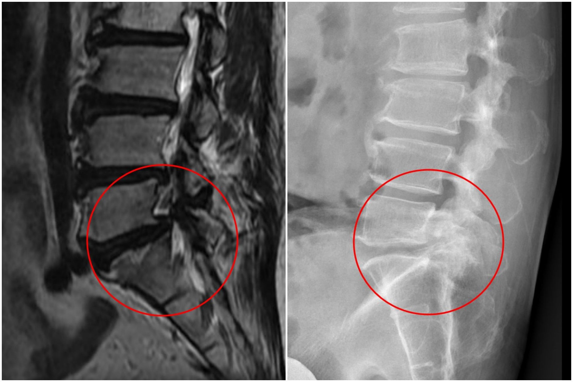 影像檢查顯示,張先生的第五節腰椎椎弓骨折合併脊椎解離。
