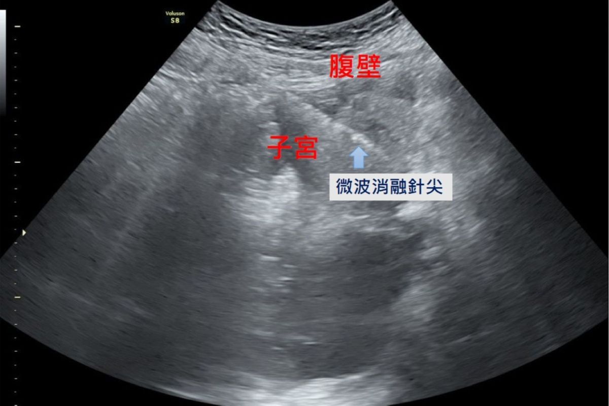 在腹腔鏡及婦科超音波的導引下，將消融針精準進入病灶，釋放高能量微波破壞異常內膜腺體組織，使其失去活性而逐漸縮小。