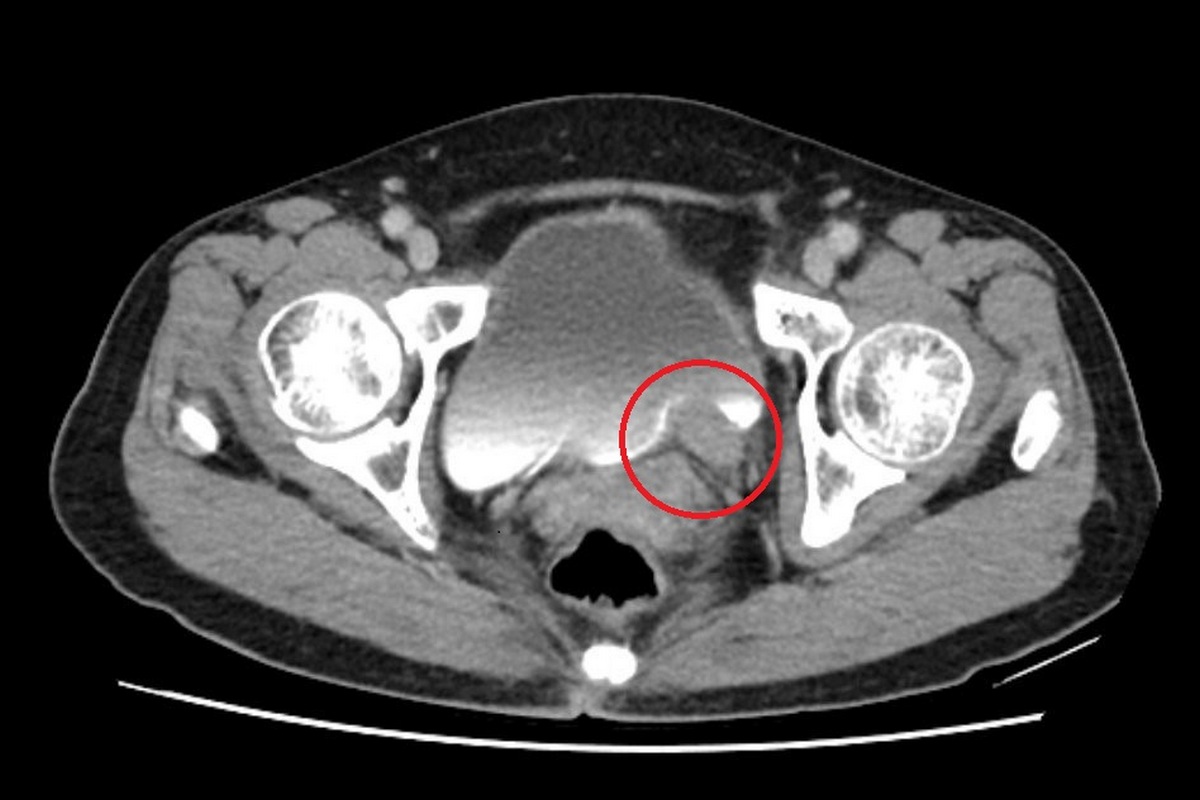 電腦斷層顯示，左側輸尿管末端有一約5公分大腫瘤。