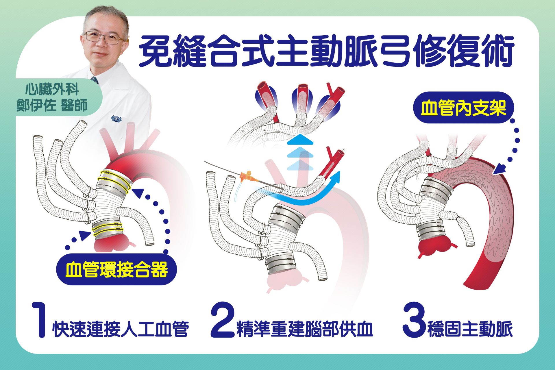 「免縫合式主動脈弓混合型手術」三步驟，讓急性主動脈剝離手術更快、更安全。