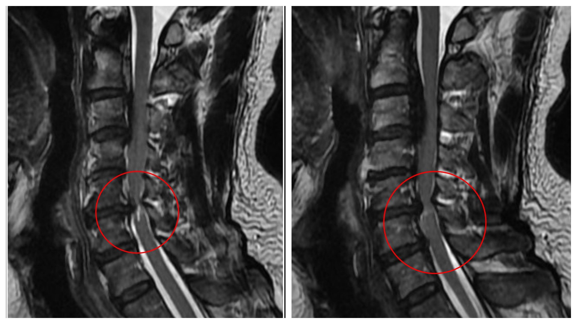 黃先生的頸椎第二節到第六節都有後縱韌帶骨花蓮慈濟化,其中第五、六節最為嚴重,脊髓已被壓得非常狹窄,核磁共振更可見明顯脊髓空洞。